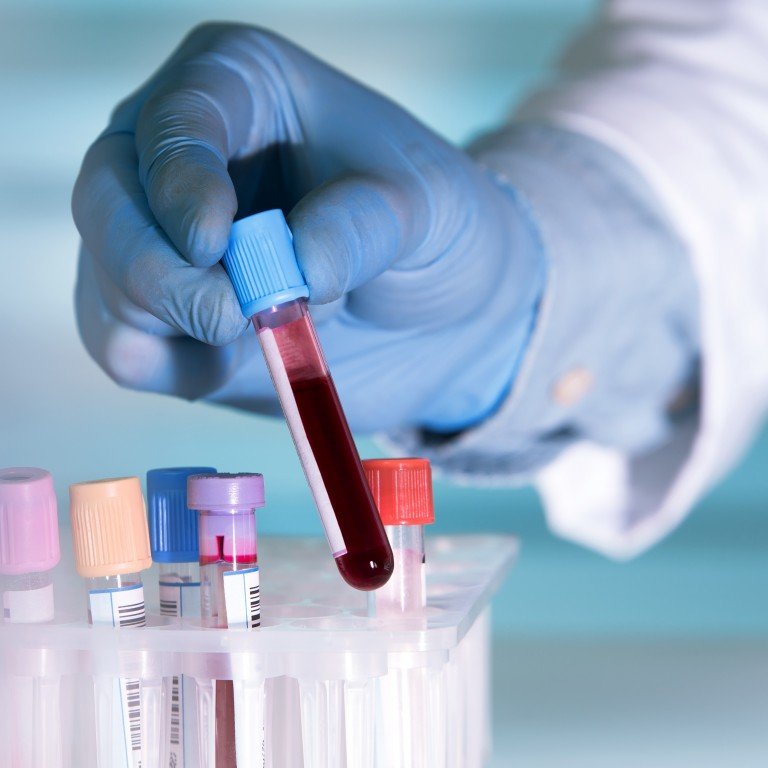 People with blood type A may be more vulnerable to coronavirus: study