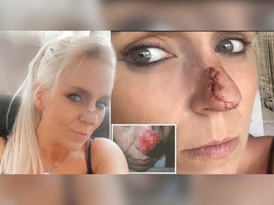 Mum refused service for not wearing face mask after dog ripped off nose