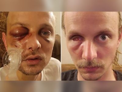 'Peaceful' BLM protester lost eye after being shot in face by police