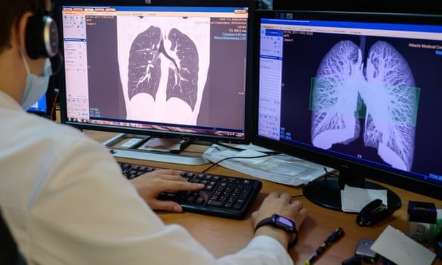 Early CT scans deliver huge fall in lung cancer deaths, study shows
