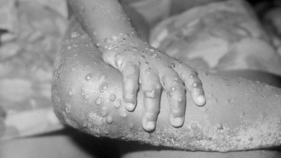 What is monkeypox and how do you catch it?