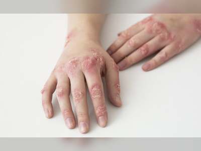 Drug-Resistant Ringworm Detected In US, Says Report