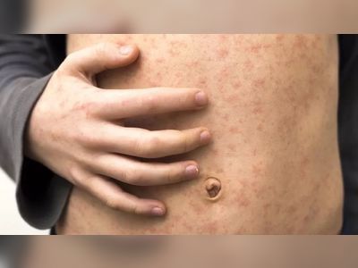 Rise in UK measles cases causing concern